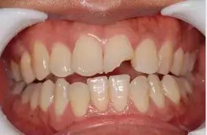 OMG，牙齿折断了怎么办？