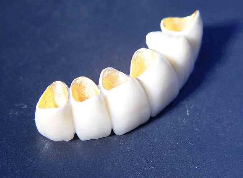 烤瓷牙可以恢复牙齿美观