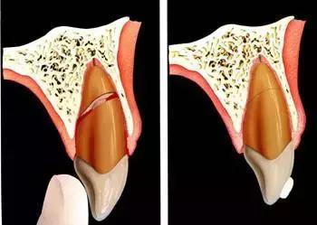 OMG，牙齿折断了怎么办？
