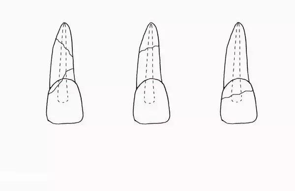 OMG，牙齿折断了怎么办？