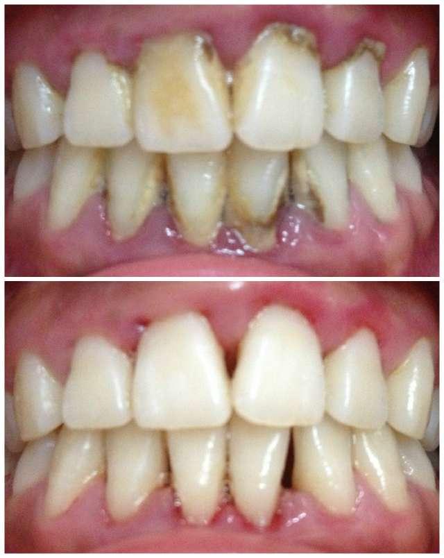 很多人对洁牙、牙齿美白、贴面修复等傻傻分不清？